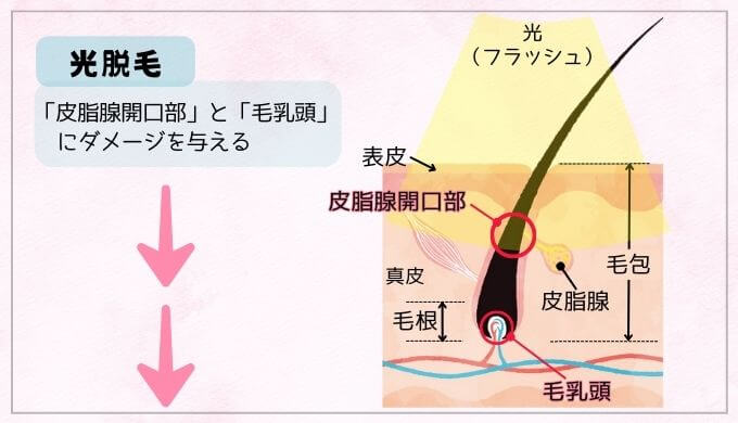 サロン脱毛のメカニズムを視覚的に説明した図