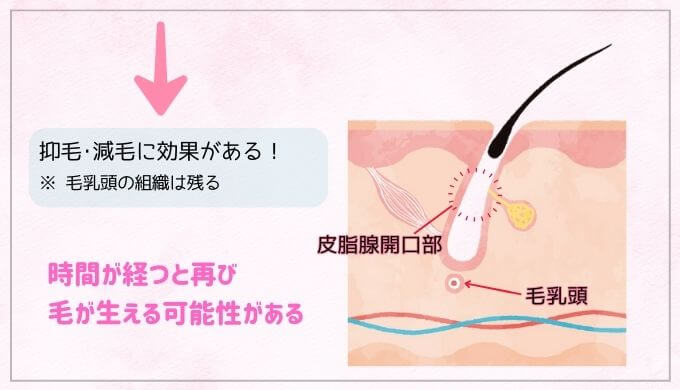 サロン脱毛のメカニズムを視覚的に説明した図