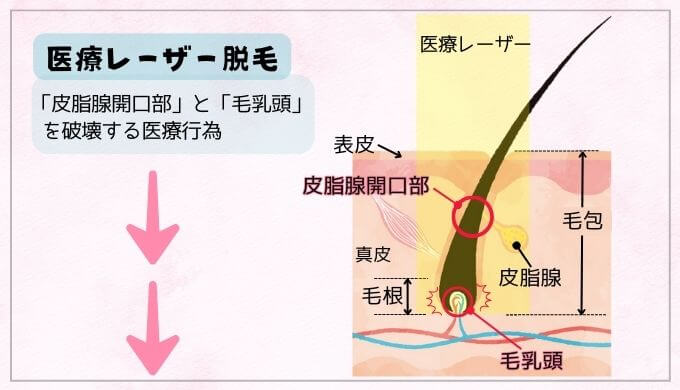 医療レーザー脱毛を視覚的に表した図